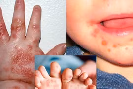 Cách phòng ngừa bệnh chân tay miệng