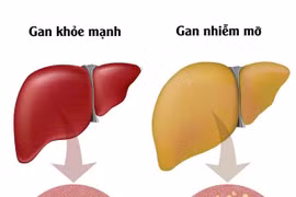 Gan nhiễm mỡ ngày càng phổ biến do lối sống hiện đại