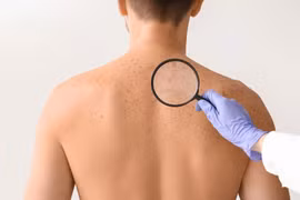 Thay đổi nhỏ trên da cảnh báo nguy cơ ung thư
