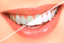 Lạm dụng tẩy trắng răng tại nhà, hại nhiều hơn lợi