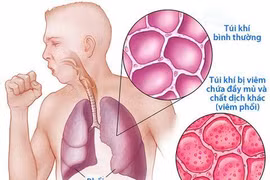 Viêm phổi nặng do vi khuẩn kháng thuốc, chớ chủ quan