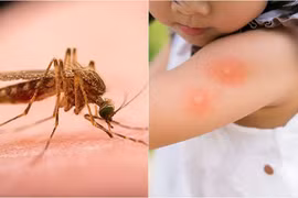 Cách xử lý côn trùng đốt
