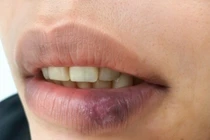 Teo môi suốt 3 năm, đi khám mắc lupus ban đỏ dạng đĩa