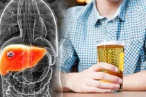 Nguy cơ mắc 4 bệnh nguy hiểm do uống rượu bia thường xuyên