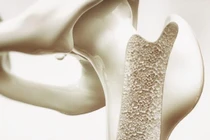 Xương dễ loãng nếu ăn nhiều 5 loại thực phẩm này