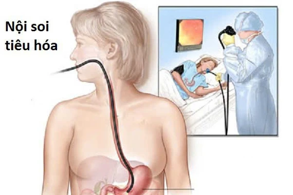 Khi nào nên nội soi tiêu hóa?