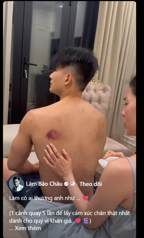 Sau khi phim Chị ngã em nâng ra rạp, Lâm Bảo Châu tiết lộ hình ảnh bị thương trong lúc quay dự án. Ảnh: FB Lâm Bảo Châu.