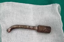 Phẫu thuật cấp cứu lấy mũi khoan cắm sâu trong hốc mũi nam thanh niên