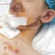 Nhiều trẻ nguy kịch vì tai nạn thương tích ngày hè