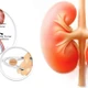 Đi khám vì sụt cân, bé trai được phát hiện Hội chứng kẹp hạt dẻ