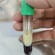 Viêm tụy cấp do không tuân thủ điều trị đái tháo đường