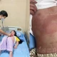 Xuất hiện nhiều trẻ mắc bệnh ban nhiễm khuẩn