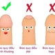 Nhiều hệ lụy khi cố lột bao quy đầu cho trẻ dưới 3 tuổi