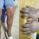 Nhiều trẻ bị ban xuất huyết biến chứng thận nguy hiểm 