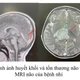Nôn ói sau ăn, bé trai phát hiện huyết khối tĩnh mạch nội sọ