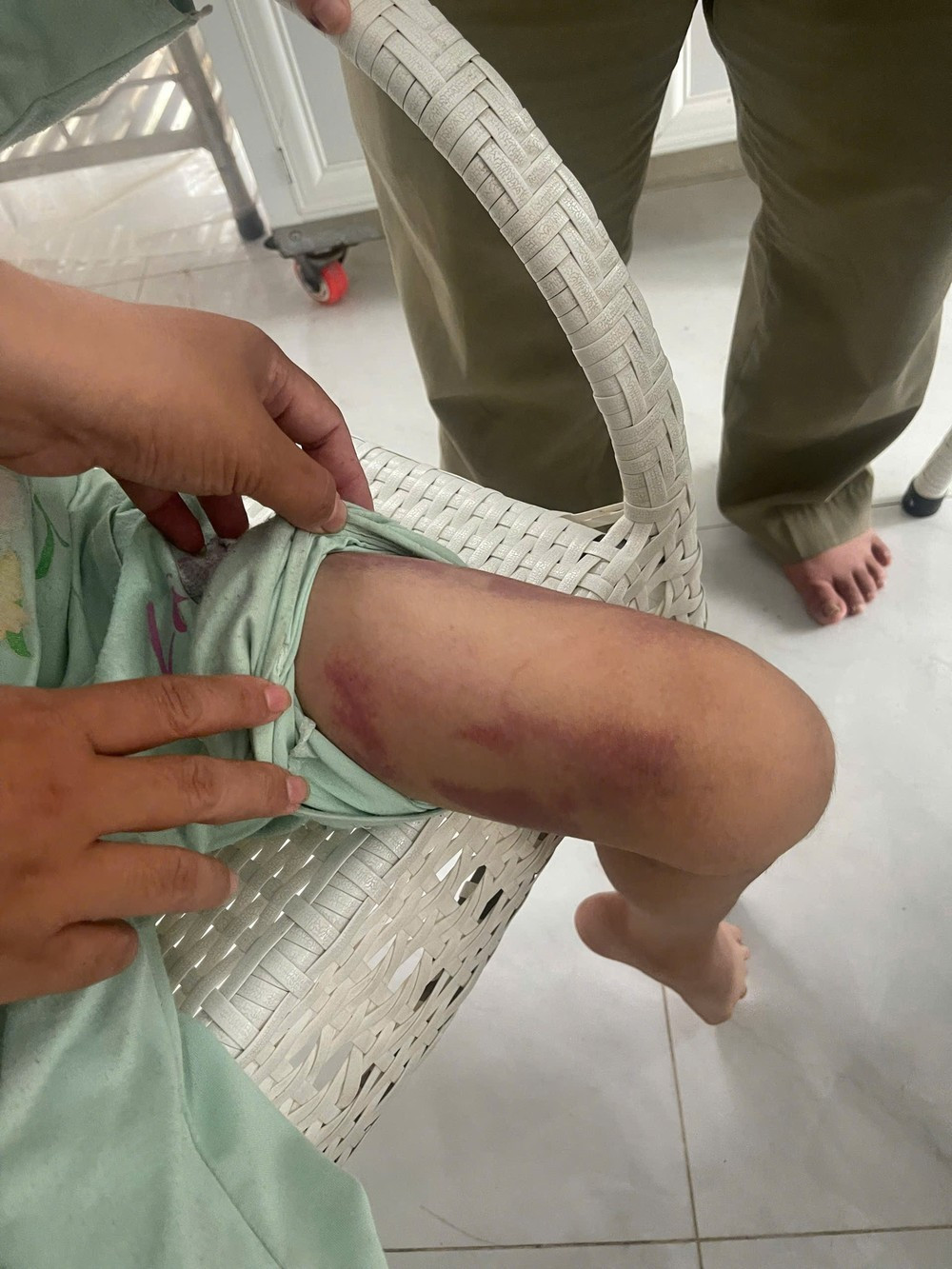 Bé T và những dấu vết bị bạo hành.