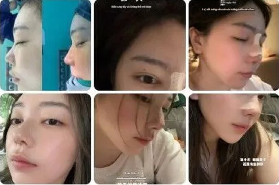 Ca phẫu thuật đã hoàn tất và mới đây Lưu Phi Nhi công khai những hình ảnh đầu tiên sau khi cắt chỉ.