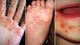 Vĩnh Long khẩn trương khống chế 5 ổ dịch tay chân miệng trong cộng đồng