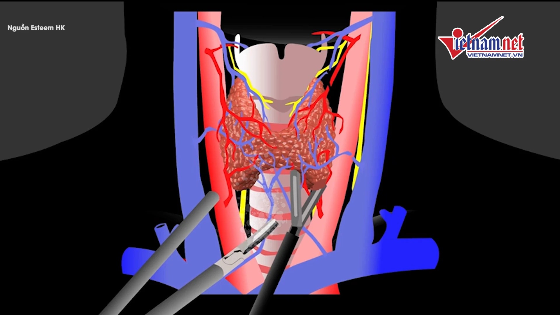 Video: Bác sĩ Việt mổ nội soi tuyến giáp 1 lỗ đầu tiên trên thế giới 