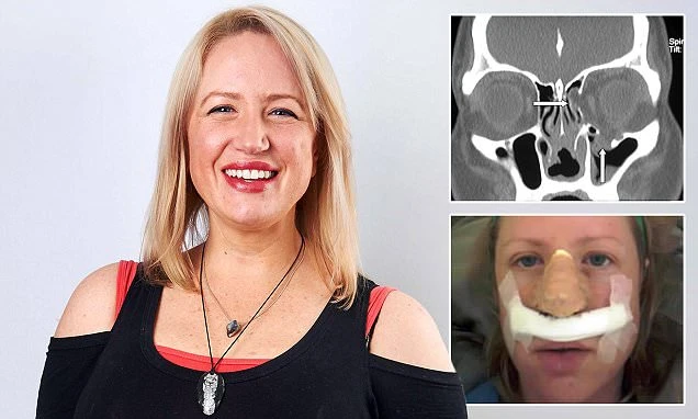 Diễn viên xinh đẹp bị bọ ăn thịt người ăn mất mũi