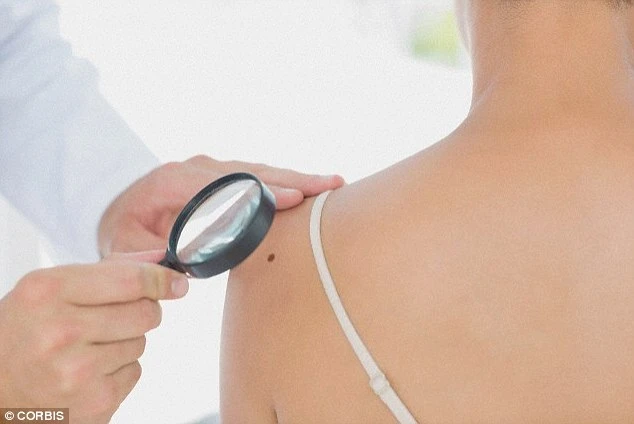 Dấu hiệu nhận biết nốt ruồi ung thư trên cơ thể bạn