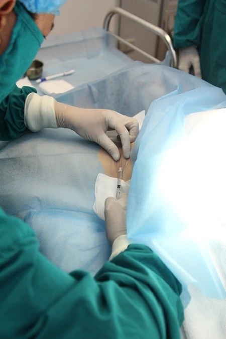 Những sự thật cần biết khi muốn tiêm botox trị hôi nách