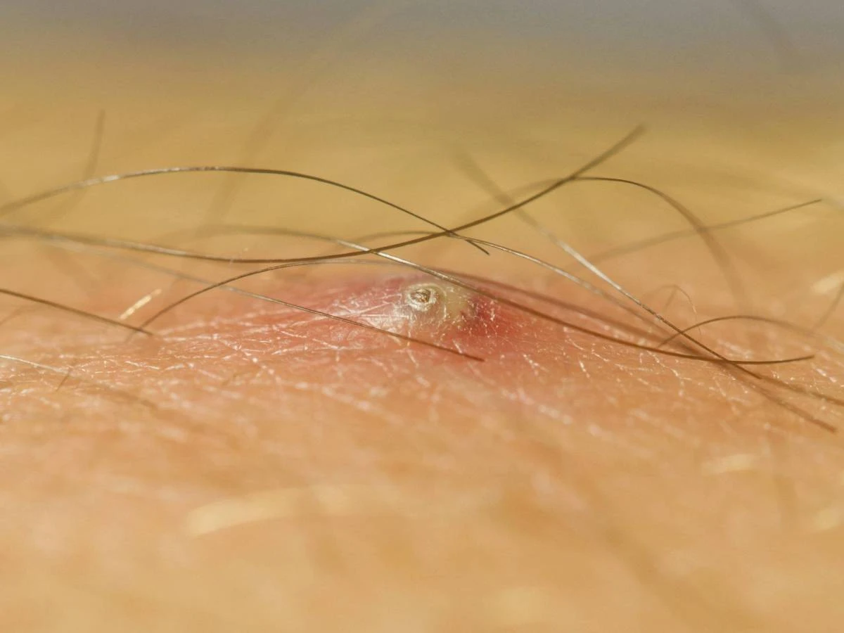 Tip phòng trị chứng lông mọc ngược dưới da