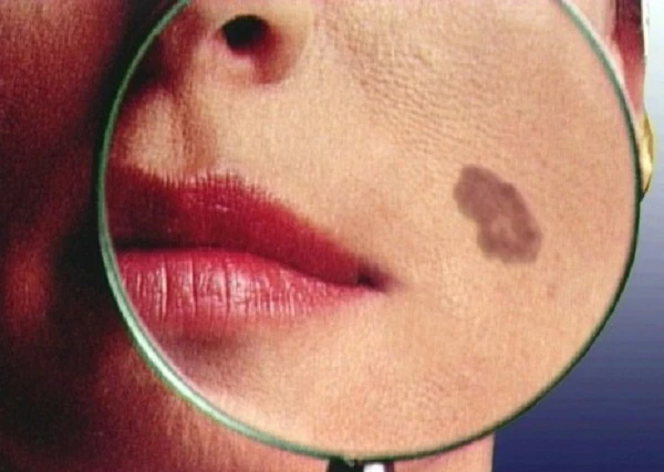 Giật mình xem rượu hủy hoại làn da một cách khủng khiếp