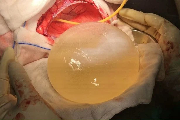 Cận cảnh nang sán to như quả bóng trong đầu bé 12 tuổi