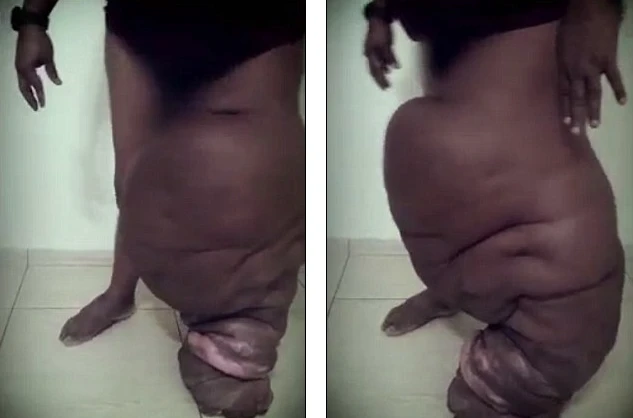 Quý ông chân phù như chân voi chỉ vì bị muỗi cắn