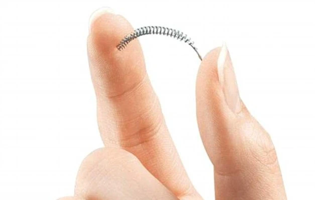 Kinh hãi hàng loạt phụ nữ thủng tử cung vì lò xo tránh thai