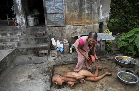 Ảnh xúc động về di chứng chất độc da cam tại Việt Nam