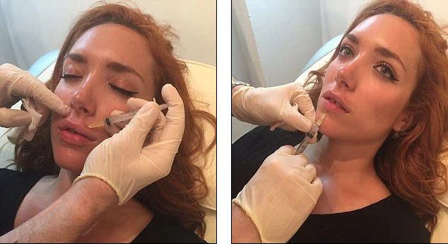 Cận cảnh tiêm nước muối vào môi để căng mọng trong 6 giờ