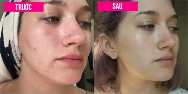 Tận mắt xem kết quả sốc sau 7 ngày không nặn mụn