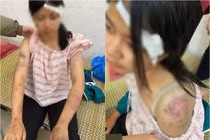 Bé gái 13 tuổi bị người nhà bạo hành vì nghi trộm tiền 