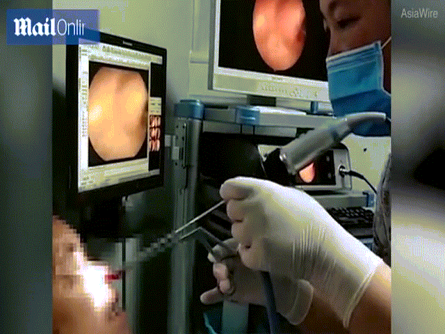 Chay mau mui nhieu ngay, di kham bac sy loi ra 2 con dia 'ngoe nguay'