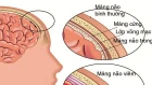 50% nhiễm trùng huyết do não mô cầu tử vong, cách gì phòng tránh