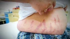 Từ con dị ứng mũi tự điều trị thành suy tuyến thượng thận