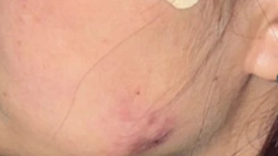 Mủ ứ đọng 2 bên má sau khi tiêm thon gọn hàm tại spa