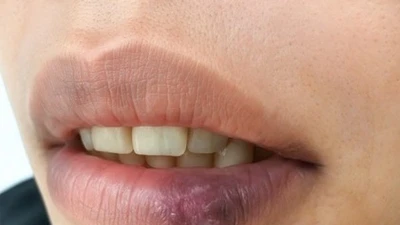  Tưởng khô môi, dị ứng đi khám mắc lupus ban đỏ dạng đĩa
