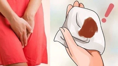 Máu kinh ra nhiều bất thường - dấu hiệu u xơ tử cung