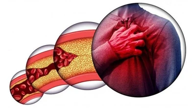 Soi gương thấy 3 dấu hiệu này có thể bạn đã bị mỡ máu cao