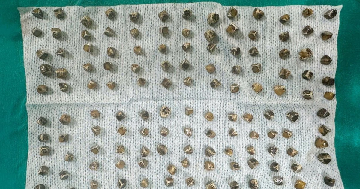 130 viên sỏi trong túi mật khiến người phụ nữ 40 tuổi viêm túi mật cấp