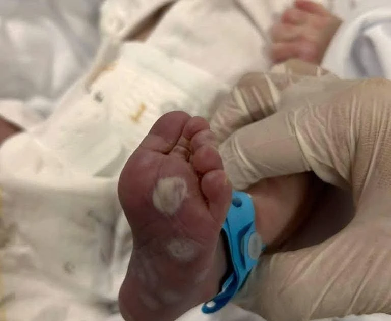 Bé sơ sinh suy hô hấp, gan lách to vì mẹ không tầm soát giang mai thai kỳ