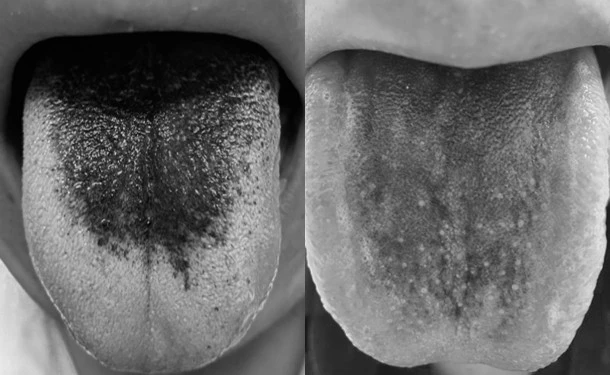 Nhiều người đi khám lưỡi đen bất thường, lo sợ bệnh nguy hiểm