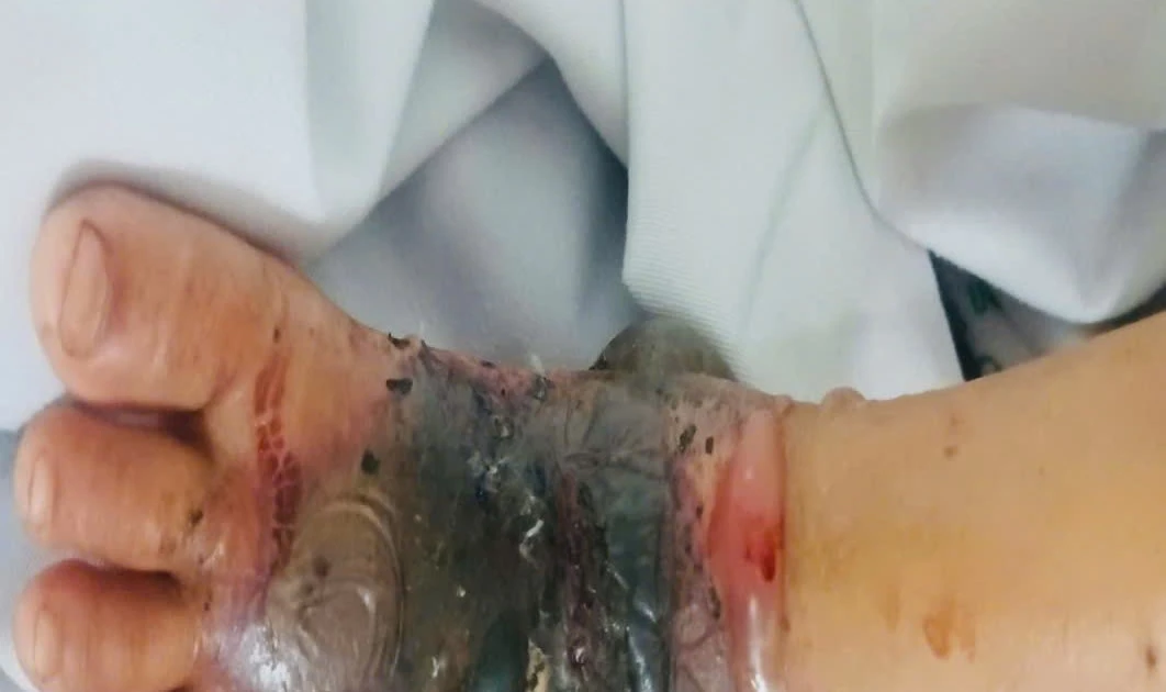 Đắp thuốc nam chữa vết mèo cắn, bé trai 4 tuổi nguy kịch