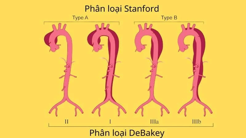 Cứu người đàn ông 47 tuổi bị lóc tách động mạch chủ