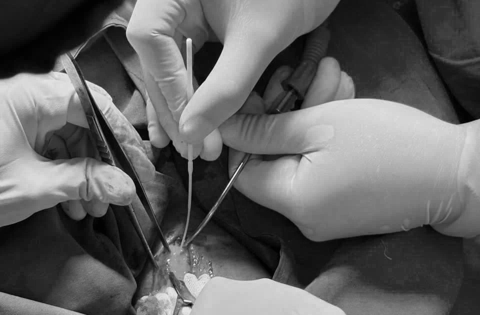 Đau răng hàm dưới không ngờ áp xe cổ nguy kịch