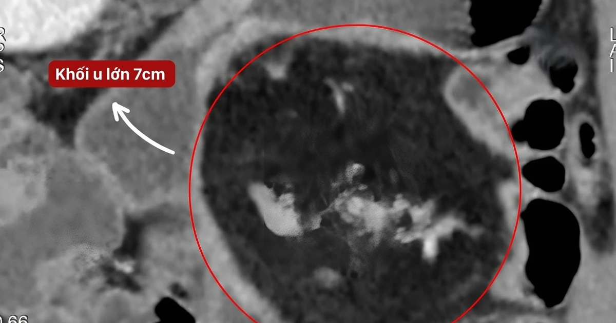 Sụt 10 kg vì bán tắc ruột tái phát hơn 1 năm không ngờ u mạc treo non