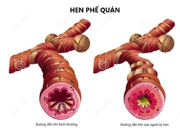 Bệnh hen và phổi tắc nghẽn khác nhau thế nào?